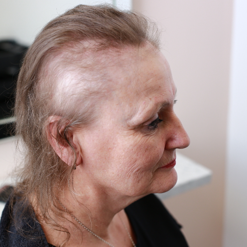 HairSolved's tweet photo. Clients find the Enhancer System to be a complete solution for both the physical and emotional effects this female hair loss condition can cause. Our solution is completely bespoke and can be modified and adjusted over time as your requirements change.
#femalepatternhairloss