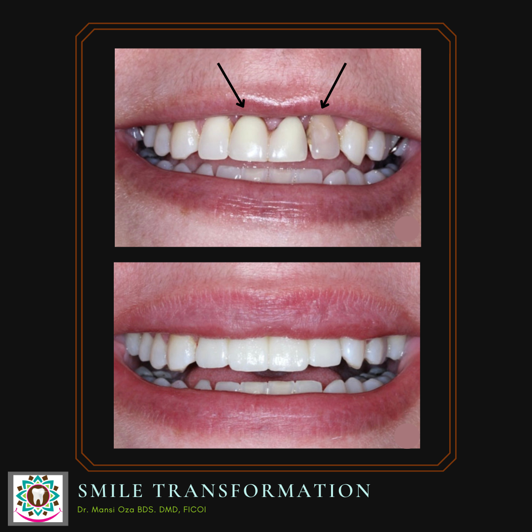 We want to help you love your smile. If you feel less than confident about your smile, you have options.
.
People often ask if enhancing their smile is expensive? How expensive is not smiling with all your heart? What is it costing you?
.
There are many material and treatment opt