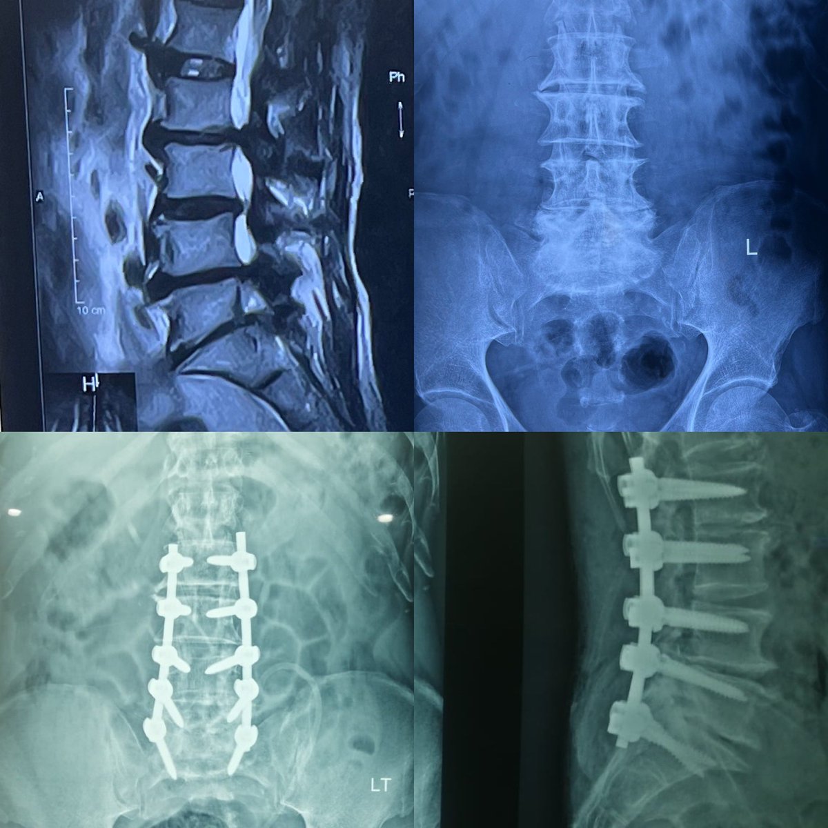 DrLatifKhan's tweet photo. Posterolateral fusion and central laminectomy in a 71 years old patient having back with neurogenic claudication for last 5 years worse for last 6 months. Postoperatively patient is doing well. #MedTwitter #orthotwitter #spine #orthotweets #Meded https://t.co/0qWJ35vlOt