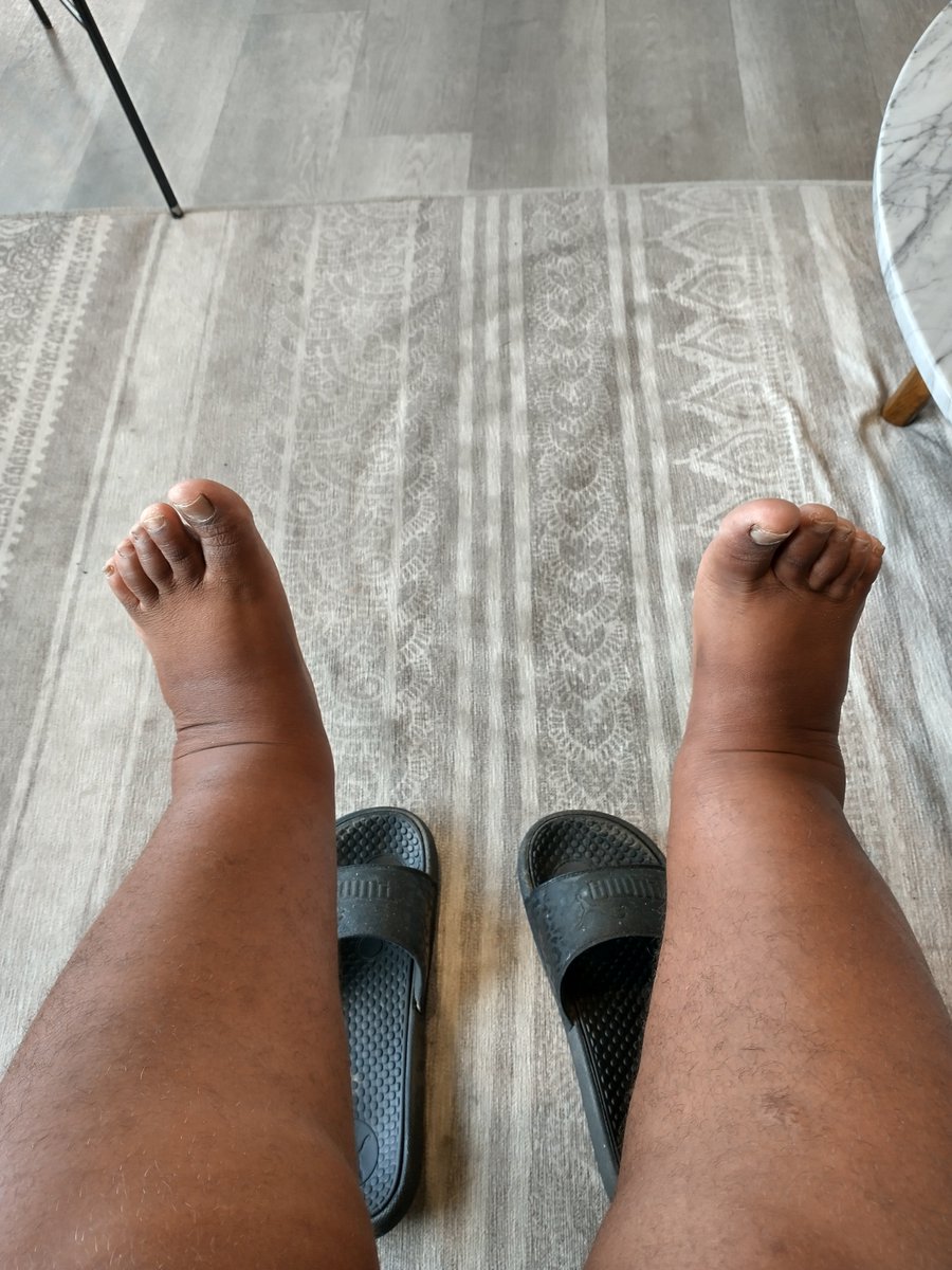 CreoleTargeted's tweet photo. Feet, legs &amp; ankles swelling due to #electronicweapons. Proof that I'm a real #TargetedIndividual!

#sleepdeprivation makes it worse. https://t.co/v42gZrfJln