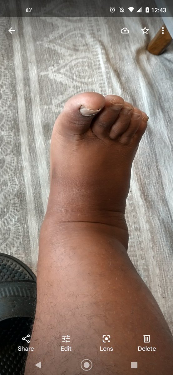 CreoleTargeted's tweet photo. Feet, legs &amp; ankles swelling due to #electronicweapons. Proof that I'm a real #TargetedIndividual!

#sleepdeprivation makes it worse. https://t.co/v42gZrfJln