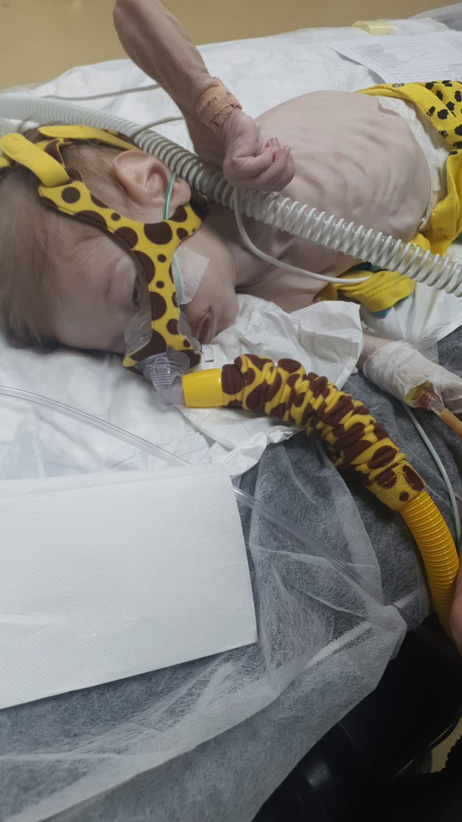 Arden Ömer; 11aylık sma hastası.2.kez mide kanaması sebebiyle hastanede. Mama alerjisi kilo almasını engelliyor o sadece 4 kg. Gözkapakları kapanmadıgı için gözleri açık uyuyor. ONU GÖRÜYOR MUSUNUZ DUYUYOR MUSUNUZ?
#SONDAKİKA #Felix #kpssiptaledilsin
