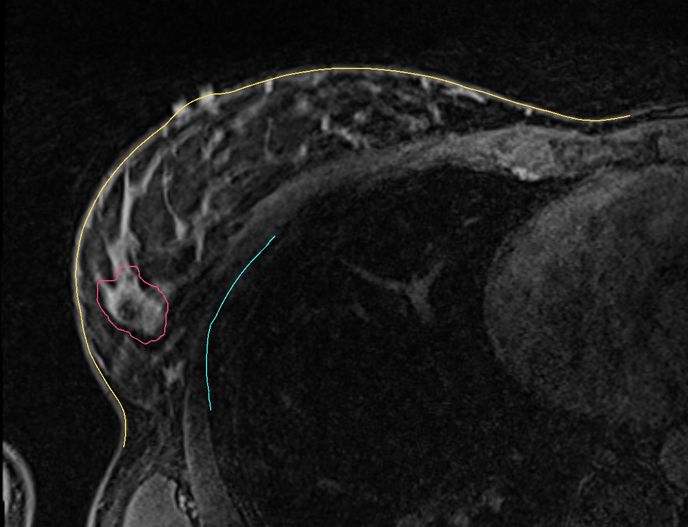 MRI is an excellent modality to image #BreastCancer, and supine MRI images the patient in their surgical position. 

CairnSurgical is developing a surgical tool using supine MRI data designed to provide precise guidance for #BreastSurgeons. Learn more. cairnsurgical.com/breast-cancer-…