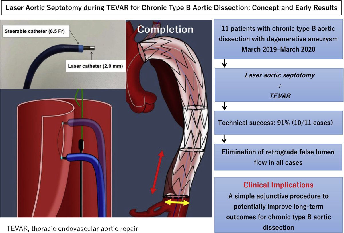 Laser aortic septotomy during thoracic endovascular aortic repair for chronic type B aortic dissection. Read the full JTCVS article by <a href="/ShinFukuharaMD/">Shinichi Fukuhara, MD</a>, <a href="/VIRkhaja/">Minhaj S Khaja, MD, MBA</a>, et al: doi.org/10.1016/j.jtcv… <a href="/LiseTchouta/">Lise Tchouta_MD</a> <a href="/RudyMDIR/">Rudra Pampati</a> #JTCVS #CTSurgery #cvsurg #CardioTwitter <a href="/AATSHQ/">AATS</a> <a href="/tssmn/">CTSurgSocMedNetwork</a>
