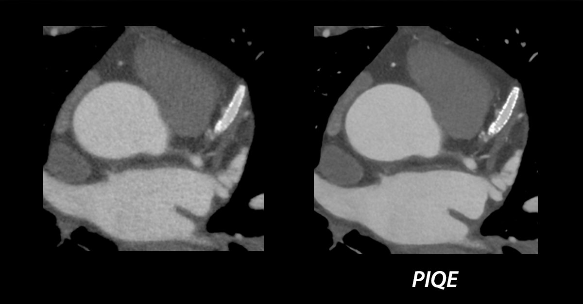 CanonMedicalANZ's tweet image. Obtain greater diagnostic accuracy with the industry’s only super resolution #DeepLearningReconstruction technology for #cardiac #CT – Precise IQ Engine (PIQE), powered by Altivity.

Visit the Canon team at #RANZCR2022 to hear more  bit.ly/3vvLtBR