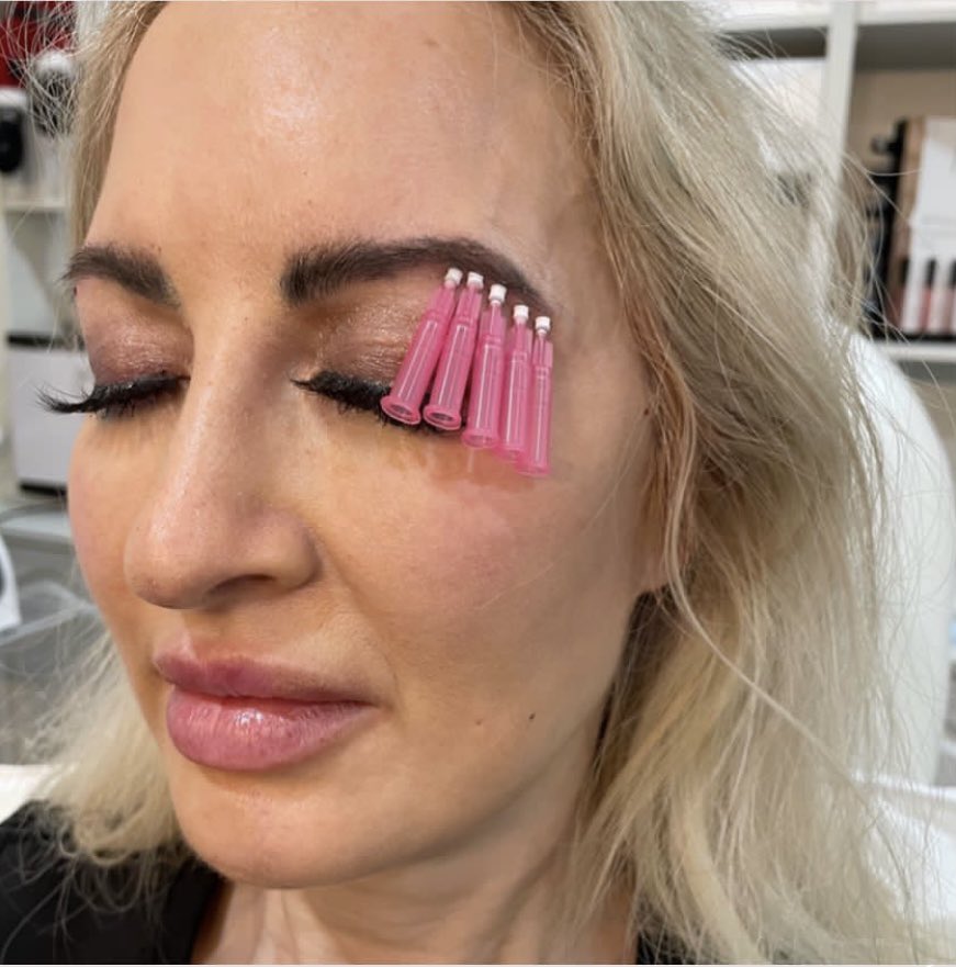 AliceSutures's tweet image. Smooth threads….. small but
mighty.
These little guys can be great to minor lifting,
building volume, and building support beneath the
Skin.
Stay tuned for our upcoming promos to take
advantage of these smooth threads!
#liftingthread #liftingthreads