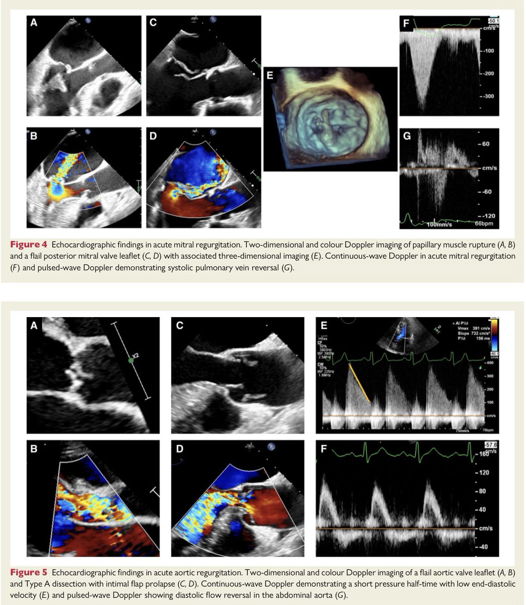 paomorejon's tweet photo. 📌Emergencias por valvulopatías agudas🫀

😉Olvida los epónimos de la IAo crónica
❌Bradicardia en la IAo aguda

🩺30% con IM aguda por SCA no tiene soplo

#POCUS puede retrasar el diagnóstico

💔Shock cardiogénico
IM—>ECMO-VA
IAo—>ECMO-LAVA

https://t.co/dKxq2UdZ0d
#CardioEd https://t.co/ioGpuBzjit