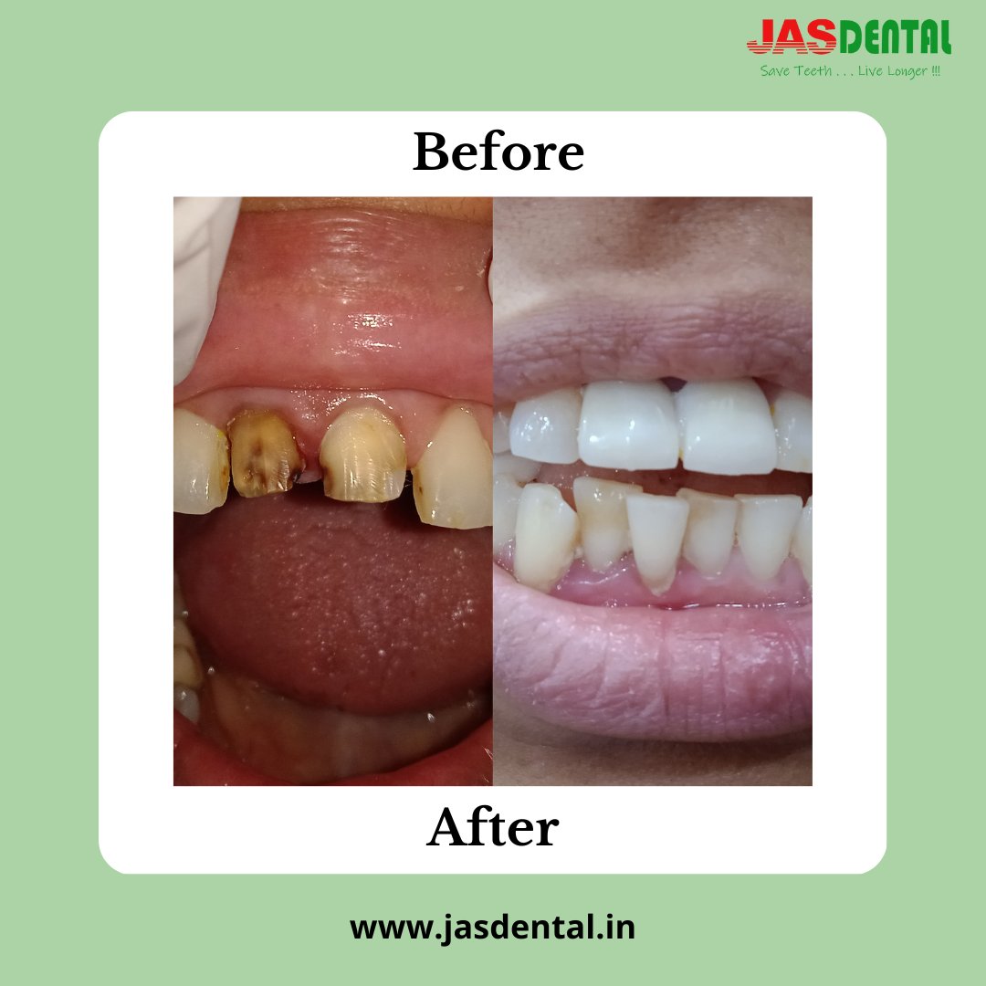 jasdental's tweet image. A 45 year old lady had visited with the complaint of upper front teeth decayed  We treated her front two teeth with root canal procedure and placed a cap for the same

#teethcap #rootcanal #teethdecay #JasDental #saveteethlivelonger #toothgap #dental #dentalcare #beforeandafter