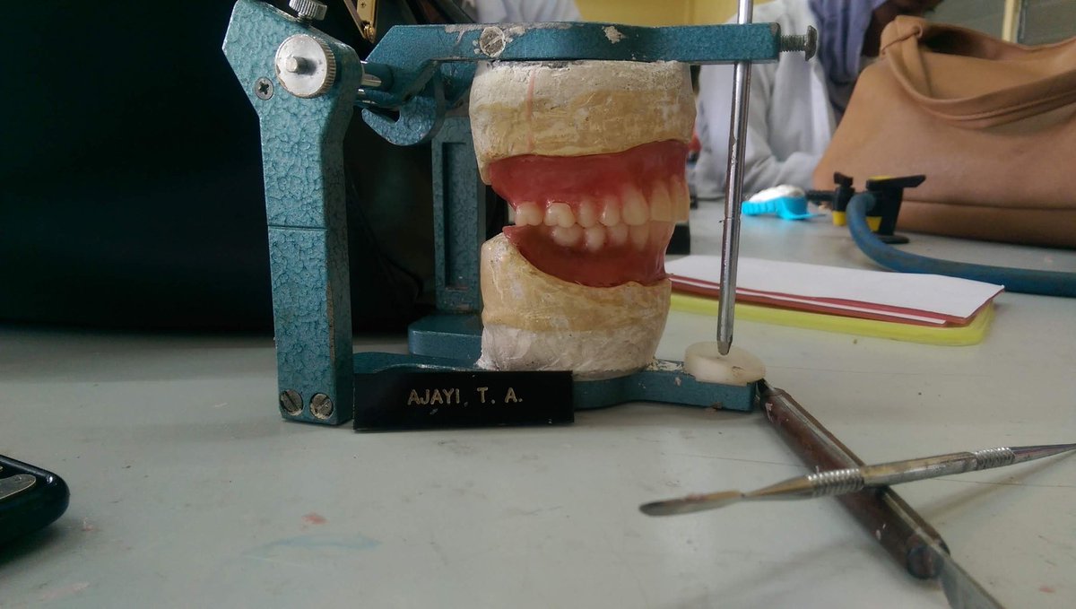 tolz_baby's tweet photo. Throwback to this nightmare
Can't believe it's been 6 years
Who here still has pictures of their full full framework? I want to see if mine was the coolest🤣🤣😍
P.S: Shine ya wax!
#dentist
#fullfull 
#completedenture 
#dentalschoolwasanightmare https://t.co/cmRIcF2HQx