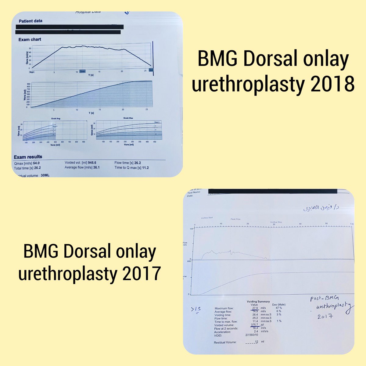 Two case of urethral stricture treated with urethroplasty BMG with 5 Years follow-up. Great thanaks to my Godfather <a href="/sanjaybkulkarni/">Dr Sanjay Kulkarni</a>. <a href="/ISORU1/">ISORU</a> <a href="/drjoshi_pankaj/">Pankaj M Joshi</a> <a href="/SocietyGURS/">GURS</a> <a href="/SIU_urology/">SIU-Urology</a> More than 200 cases done in #kuwait