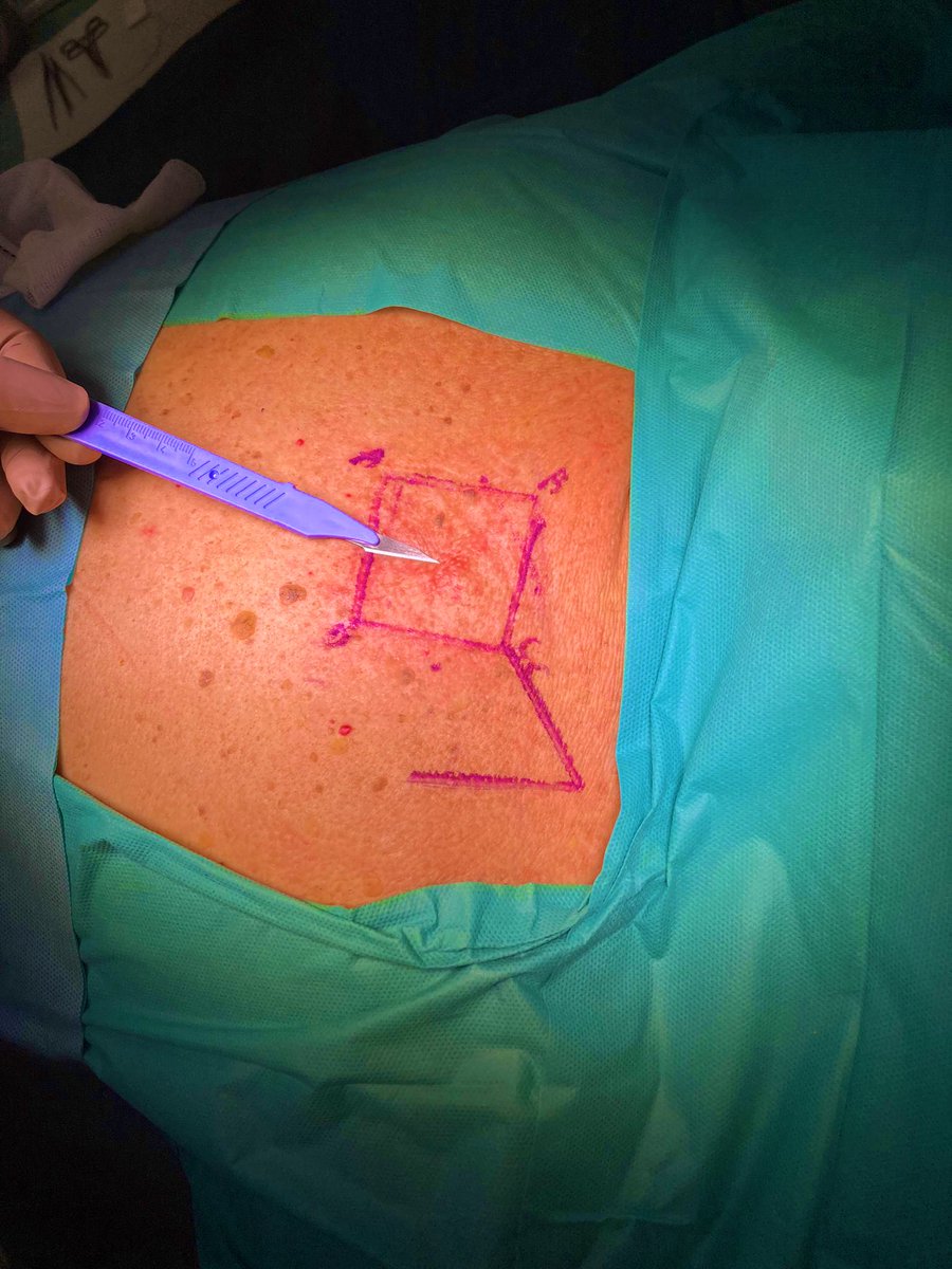 equipodrduran's tweet photo. El #melanoma es el tumor maligno de piel más frecuente. Un factor de riesgo para su desarrollo son las quemaduras solares. La #cirugía es el único tratamiento curativo aunque lo primordial es la prevención o la detección temprana #dermatologia @Hospital_LaLuz #protegetedelsol https://t.co/1BWhSeL8v0