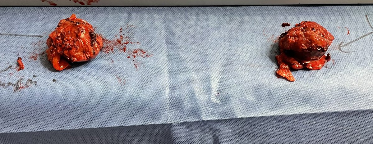 RoboticsUrology's tweet image. Here is another example of advancing technology in robotics allowing us to do complex cases just via one unique incision! Reduces postop pain, wound infection, hernia and going 🏡 same day. #SProbot @SocietySURS @Endo_Society @AmerUrological