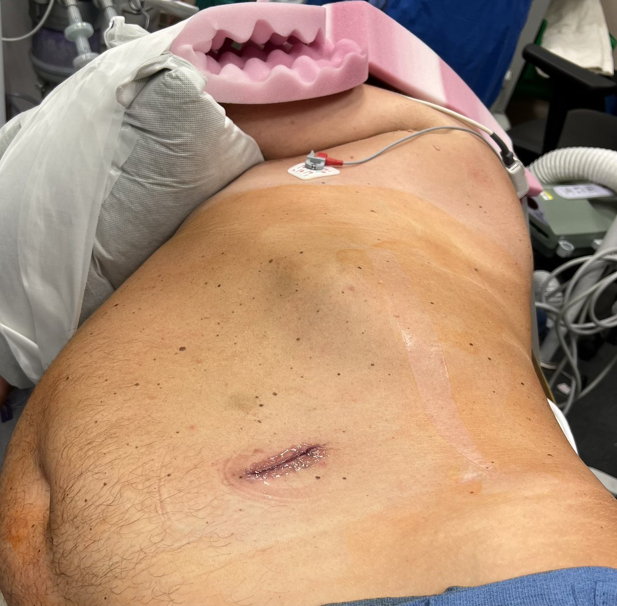 RoboticsUrology's tweet image. Here is another example of advancing technology in robotics allowing us to do complex cases just via one unique incision! Reduces postop pain, wound infection, hernia and going 🏡 same day. #SProbot @SocietySURS @Endo_Society @AmerUrological