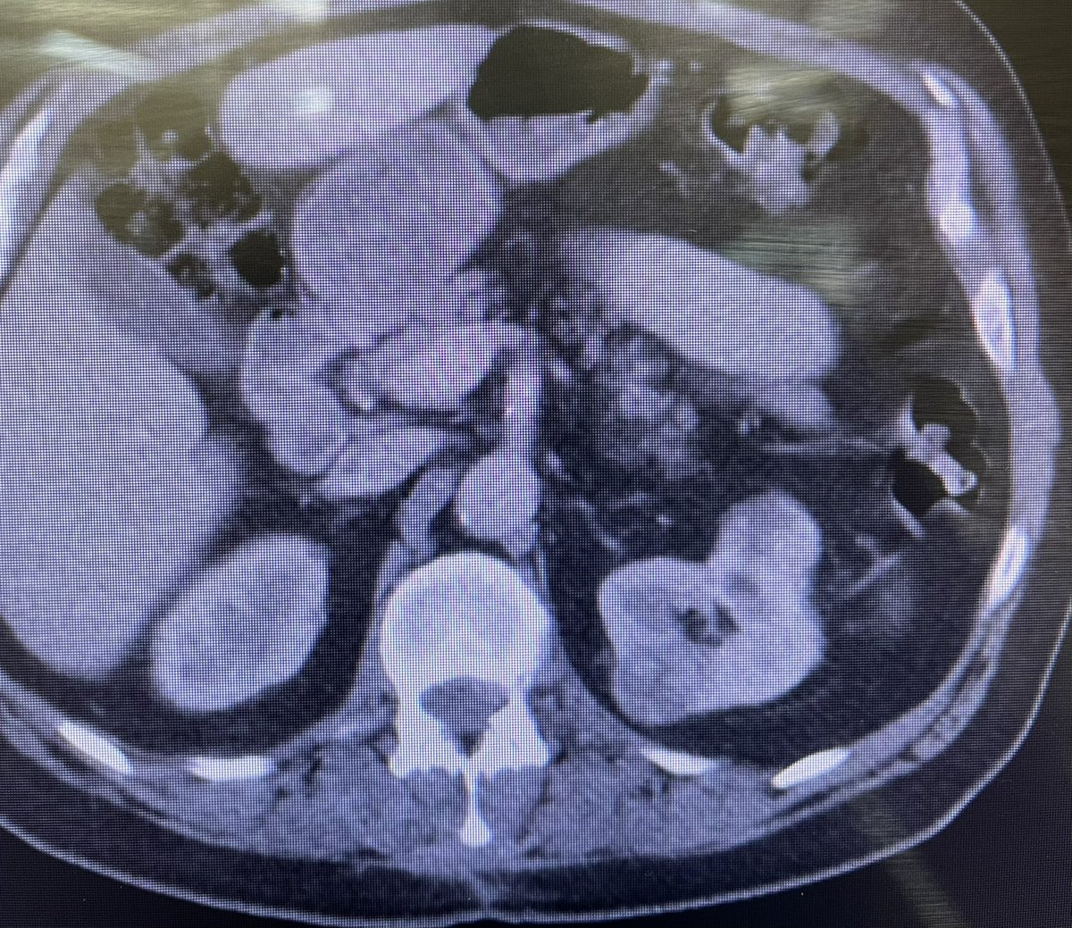 RoboticsUrology's tweet image. Here is another example of advancing technology in robotics allowing us to do complex cases just via one unique incision! Reduces postop pain, wound infection, hernia and going 🏡 same day. #SProbot @SocietySURS @Endo_Society @AmerUrological