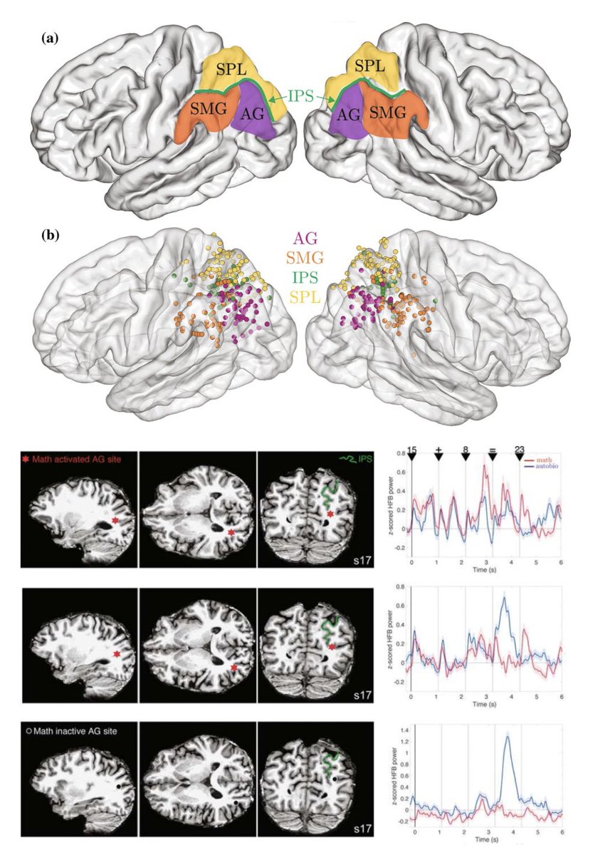 josef_parvizi's tweet image. Where fMRI gets it wrong: Less deactivation = activation & native brain space = standard MNI space. What intracranial EEG reveals about the brain's functional architecture in mm scale is astonishing! Fig4 is must see!
doi.org/10.1007/s00429…