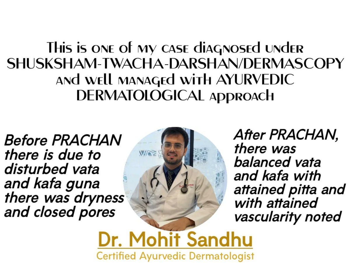 dr_sandhu2's tweet photo. Benifits of SUKSHAM-PRACHAN/MICRONEEDLING in cosmetology and dermatology
Ayurvedic Dermatology
#agnikarma #shusrutsamhita #shusruta #bamsstudents #dermatologist #dermatology #ayurvedicdermatology #skincare #instagram #fashion #dermascope #microneedling #bamsdoctors #bams #docto https://t.co/Qupk4LuAml