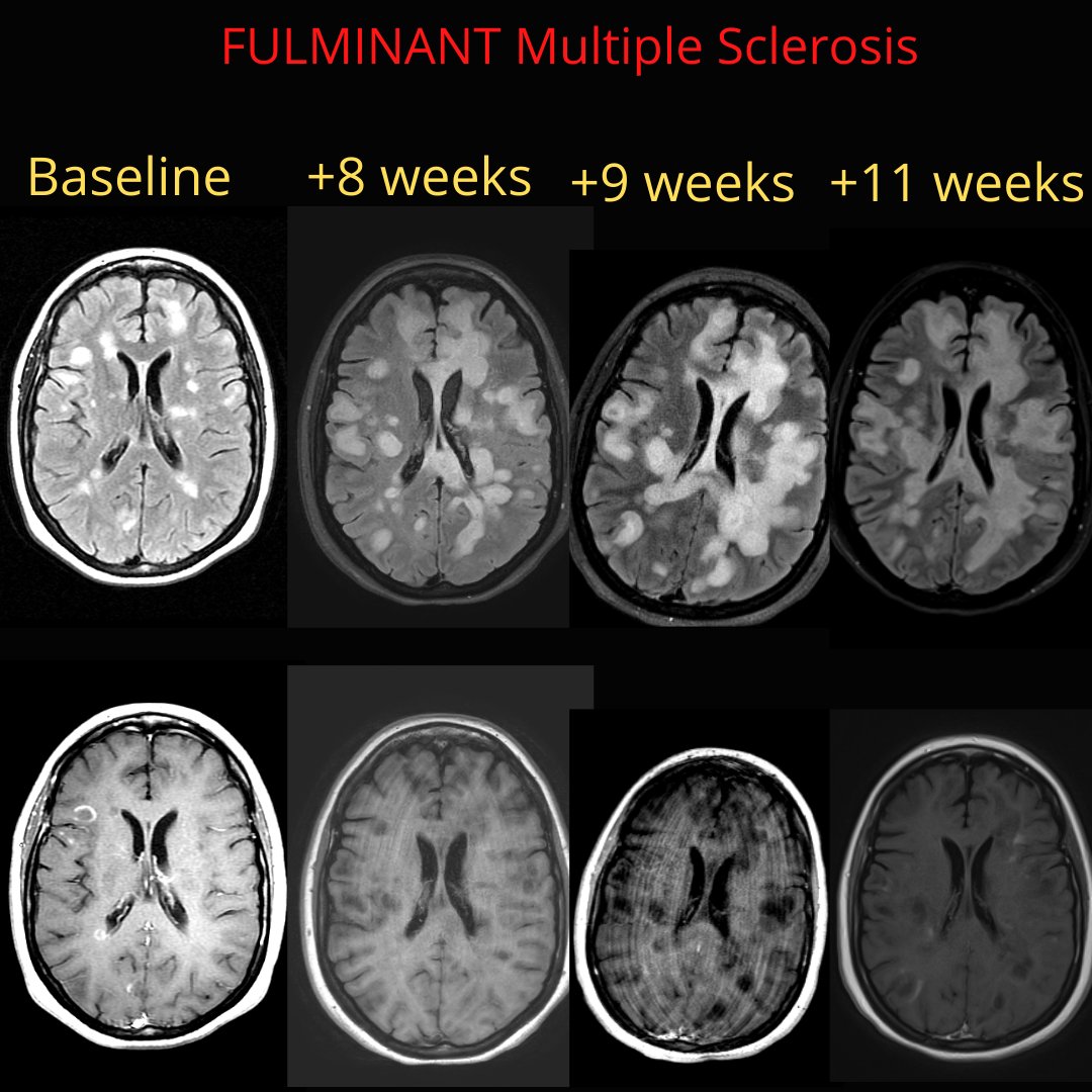 NeuroimagingN's tweet photo. Fulminant Multiple Sclerosis (MS)
·
The patient started on high-dose steroids and plasmapheresis after week 8 but still progressed. Also received cyclophosphamide with no response either.
·
Pathology of the tissue demonstrated demyelination.

#MS #Multiplesclerosis #neurotwitter https://t.co/6QPEH6KrEX