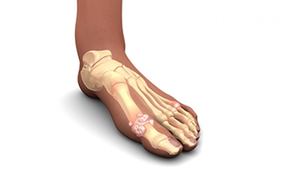 InStrideFoot's tweet photo. Joint Pain in the Feet May Indicate One or More Type of Arthritis https://t.co/9pL6YBmFMa https://t.co/sjOwAAGdM3