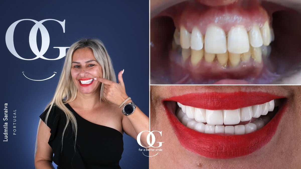 dtozanguner's tweet photo. Ludmila visited us from the Portugal for her perfect OG Smile! We made 3 dental implants and 24 porcelain crowns for her. Smile forever Ludmila!
๐+491783233900
#ogsmile #dentist #dentalclinic #dentista #dentalimplants #medicaltourism #dentaltourism #veneers #porcelaincrowns https://t.co/nOBMF6Pody