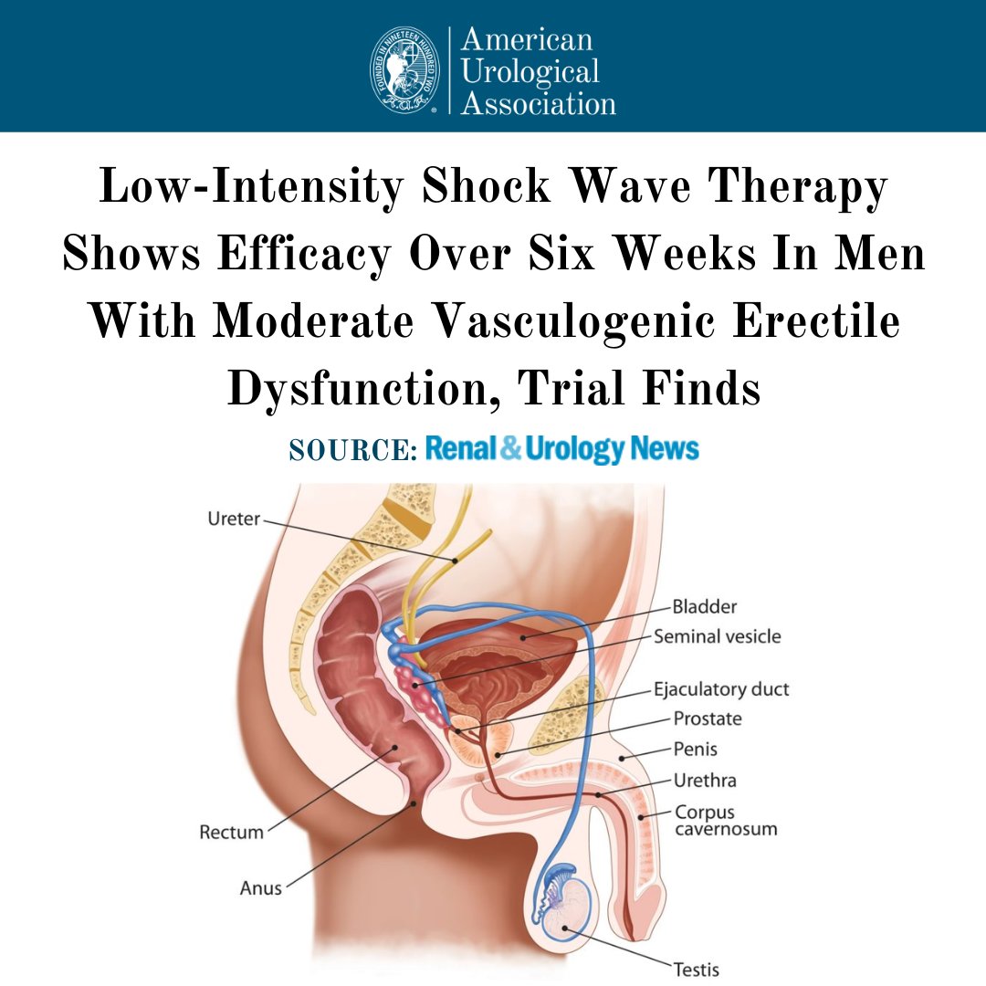 AmerUrological's tweet photo. "Low-intensity shock wave therapy shows efficacy over 6 weeks in men with moderate vasculogenic erectile dysfunction (ED), according to new trial findings." #Urology #MensHealth

Source🔗 https://t.co/euqTviaI5W https://t.co/B1LykFiq32