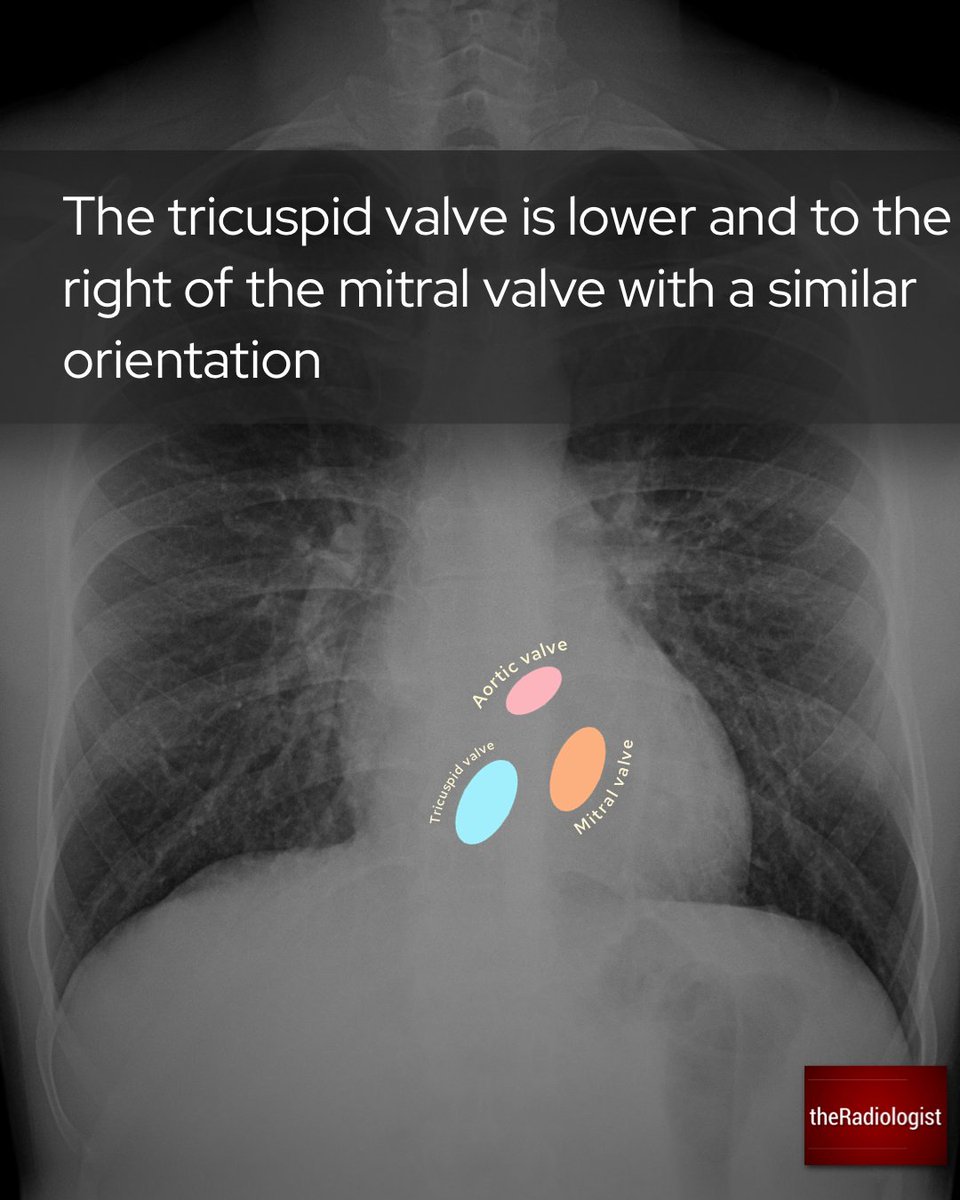 Identifying valve replacements on a frontal CXR 1/4 https://t.co/I7GKjJPPlK