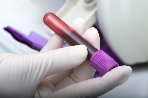 BristolUni's tweet photo. Are we closer to a simple blood test for the most common brain cancers? 💉🧠

Using mathematical modelling Bristol's @johanna_blee &amp; team found lower #biomarker thresholds could be key to developing an affordable, GP-based blood test for glioblastomas 👉 https://t.co/gLKNRDPZii https://t.co/2DdVVGzwWZ