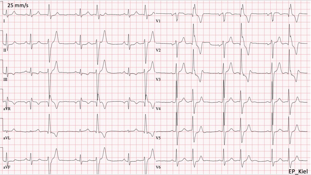 30yo man,no cardiac history,no medications
#EPeeps guess the origin of PVC!
Mapping and ablation, as always, come soon😉
#CardioTwitter  #FOAMed  #EP_Kiel <a href="/evgeny_lyan/">Evgeny Lian</a> <a href="/ThomasDemming/">Thomas Demming</a> <a href="/EPeeps_Bot/">EP_Bot</a> <a href="/EcgKiel/">ECG_Kiel</a>