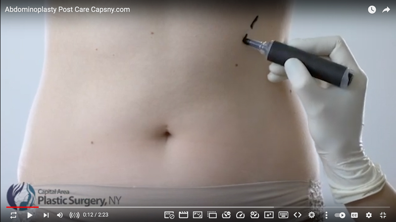 CapsnyCosmetic's tweet photo. Care Instructions After Abdominoplasty - https://t.co/Wfi8eLK17O https://t.co/C19Spb4JkV