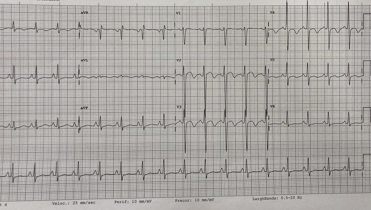 _…A night shift under pressure...
(part 1)_

👤 30 y.o. man, without CV history
🏥go to the emergency room for epigastralgy for about ten days, increased in the last few hours.
EKG below. PA 250/150 mmHg.❤️‍🔥
The echo shows a mildly dilated LV, FE 20%.
What's your hypothesis?