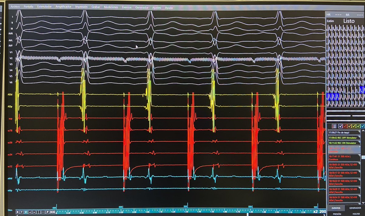 José Alderete M (@jalderetem) on Twitter photo Beautiful accessory pathway potencial of a left anterolateral AP. Pacing from distal CS. Loss of pre-excitation within 2 seconds of RF application with disappearance of AP potential #EPeeps <a href="/jordiperezrodon/">Jordi Pérez Rodón, MD, PhD</a> <a href="/DrBerruezo/">DrAntonioBerruezo</a> <a href="/diegopenela1/">diego penela</a> <a href="/AlmorJulio/">Julio Marti Almor</a> <a href="/DrFalasconi/">Giulio Falasconi, MD</a> <a href="/daniviverosf/">Daniel Viveros</a> Beautiful accessory pathway potencial of a left anterolateral AP. Pacing from distal CS. Loss of pre-excitation within 2 seconds of RF application with disappearance of AP potential #EPeeps <a href="/jordiperezrodon/">Jordi Pérez Rodón, MD, PhD</a> <a href="/DrBerruezo/">DrAntonioBerruezo</a> <a href="/diegopenela1/">diego penela</a> <a href="/AlmorJulio/">Julio Marti Almor</a> <a href="/DrFalasconi/">Giulio Falasconi, MD</a> <a href="/daniviverosf/">Daniel Viveros</a>