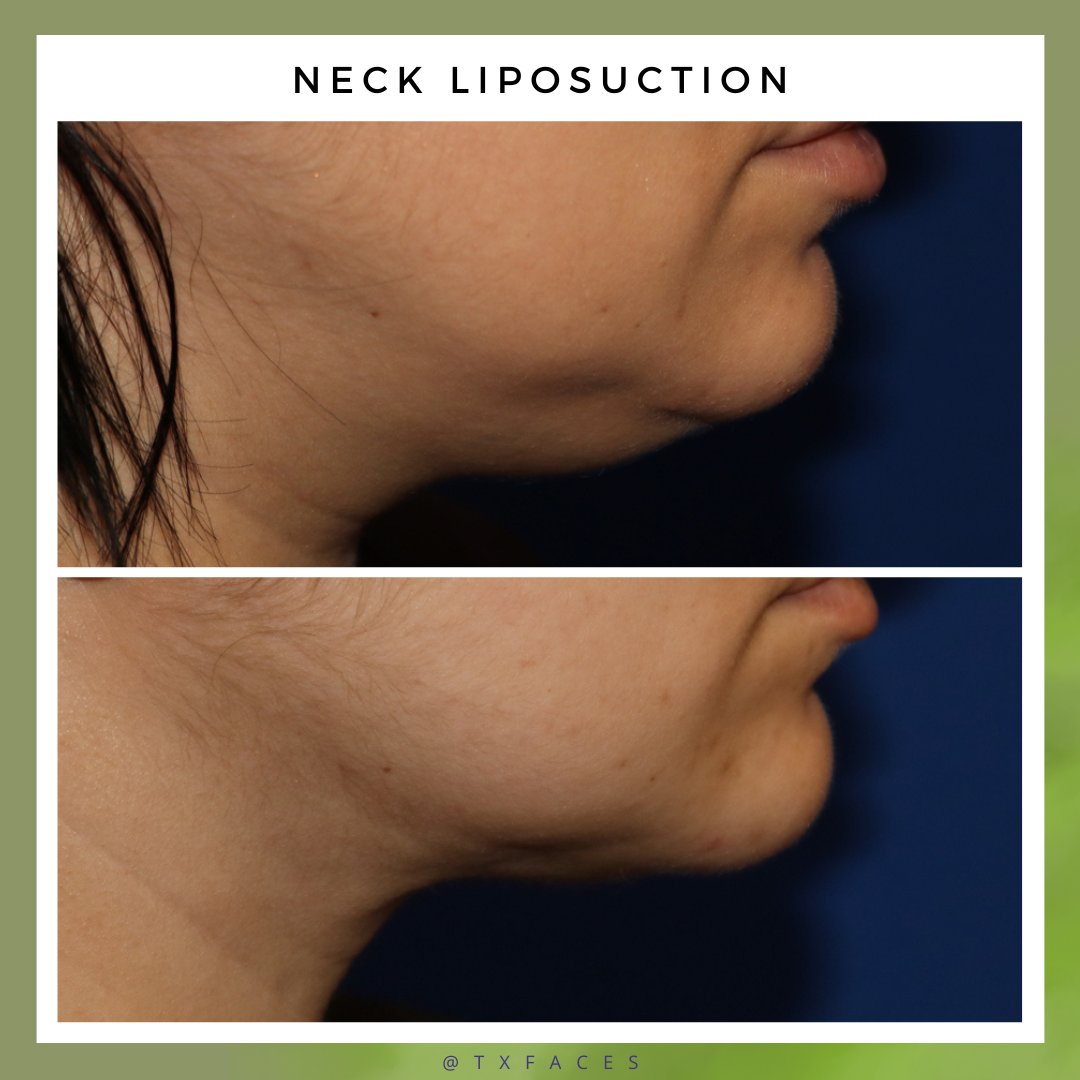 txfaces's tweet photo. This patient underwent #neckliposuction. Results are shown approximately 3 months after the procedure.
Procedure by Matthew Richardson, M.D. https://t.co/9u620FLPCq