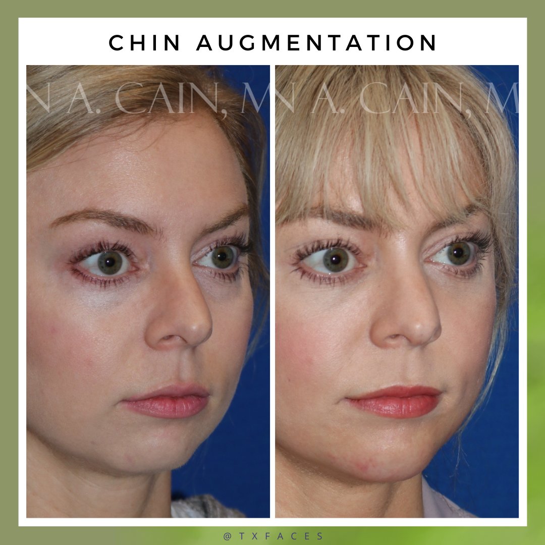 txfaces's tweet photo. This patient was treated with 2 syringes of Juvederm Voluma for #chinaugmentation. Results shown at 4 weeks after treatment. Procedure by Jordan Cain, MD. https://t.co/yzALxfA5jV