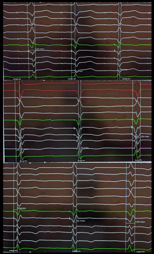 What a great start by stellar 1st yr EP fellow @ryleprz. 3 left bundle cases with excellent results @PeterJesselEP @OHSUCardFellows @B_Naz_MD @seshadribalaji6