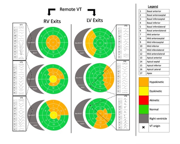 Inducible VT early (&lt;40d) post infarction arises from within scar in the majority but remote from scar in 1/8 VTs. Possible focal mechanism as noted in our prior work on VT in established SHD? Paper here👇🏼
doi.org/10.1111/imj.15…
<a href="/KaranRao_/">Karan Rao</a> <a href="/RBennett_EP/">Richard Bennett</a> @SaurabhkumarEp