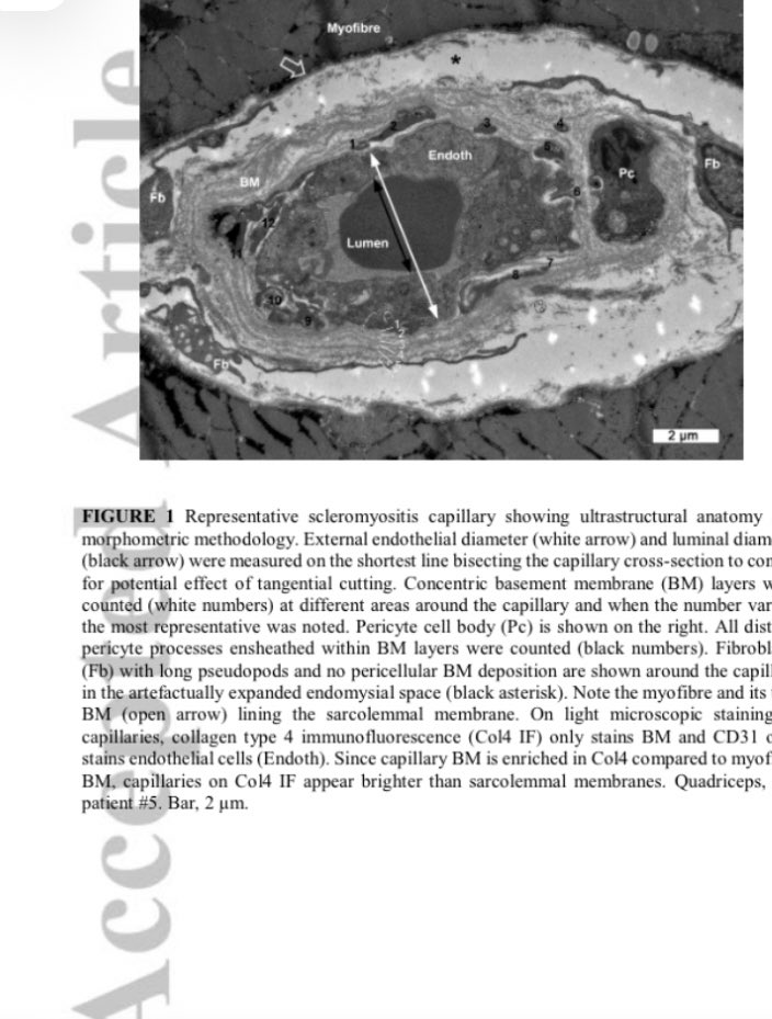 A picture is worth a thousand words! Great work on scleromyositis by @ell3zamb and Océane Landon-Cardinal! So exciting! Looking forward to more. onlinelibrary.wiley.com/doi/10.1111/na…
