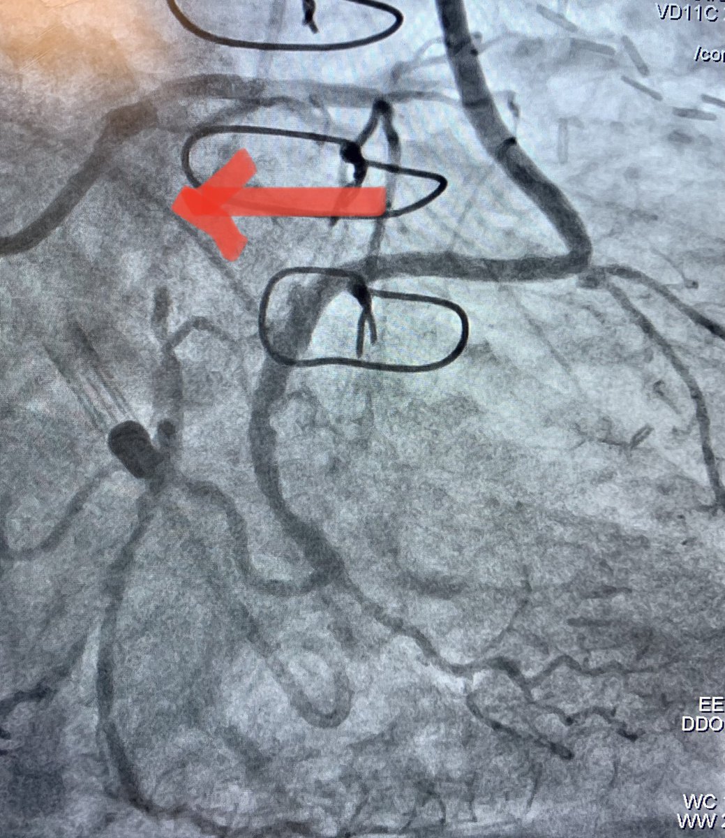 jcgeorgemd's tweet photo. #CTOPCI at #PennsyInterventions: complex retrograde CTO-PCI in HF patient with recurrent bypass graft failure using pLVAD support. 
@PennCardiology @PennCVFellows @GPAngioClub @ACVCPhila @ReVascMed https://t.co/vAfju9QK89