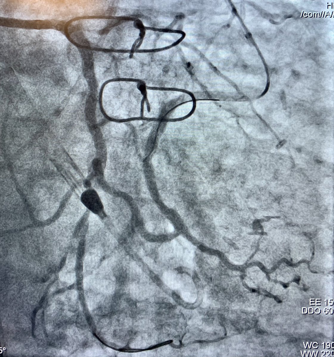 jcgeorgemd's tweet photo. #CTOPCI at #PennsyInterventions: complex retrograde CTO-PCI in HF patient with recurrent bypass graft failure using pLVAD support. 
@PennCardiology @PennCVFellows @GPAngioClub @ACVCPhila @ReVascMed https://t.co/vAfju9QK89