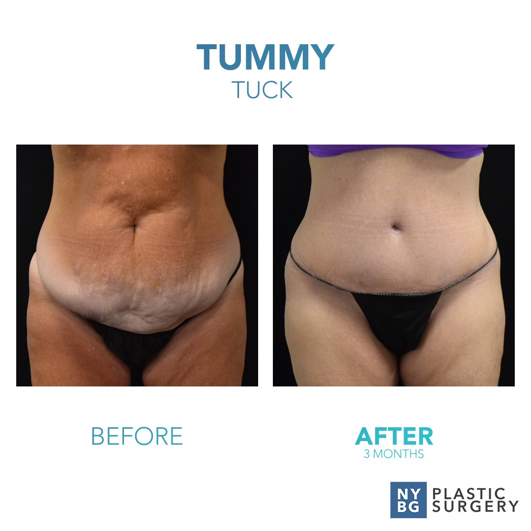 DrKevinSmall's tweet photo. These Tummy Tuck results are truly stunning! Jennifer is rocking her new look just 3 months after her procedure.

Want to see more success stories? Visit us online: https://t.co/yJguqBjz4J

#NYBGPlasticSurgery #PlasticSurgery #Success #Inspiration #Motivation #TummyTuck https://t.co/RJMZR3Y9gc