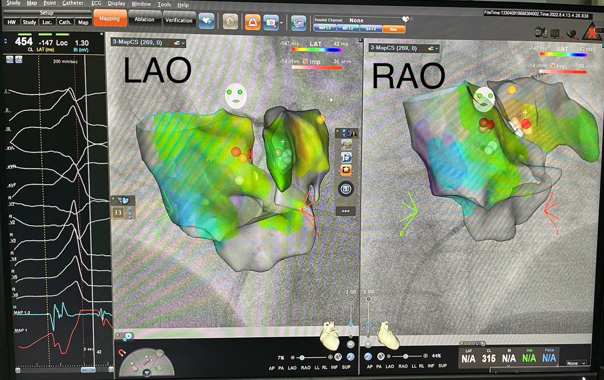 YalinKivanc's tweet photo. Summit VT ablated from Cs and aortic cusp. #CartoUnivu asisted visualization of LMCA ⁦@drerkanbaysal⁩ ⁦@MDTolgaAksu⁩ ⁦@taylanakgun⁩ ⁦@ayhankup⁩ ⁦@gokselcinier⁩ ⁦@altugyucer⁩ ⁦@BiosenseWebster⁩ https://t.co/eYBX0rpz4f
