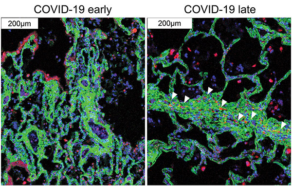 NYPAdvances's tweet photo. Experts at #NYP &amp; @WeillCornell used advanced technology to provide insights into lung pathology in #COVID19, showing a detailed picture of the disease process and how it differs from other infectious lung diseases: https://t.co/g3WoHbKO8Q CC: @WCMEnglanderIPM @ElementoLab https://t.co/d5bkoLh4fx