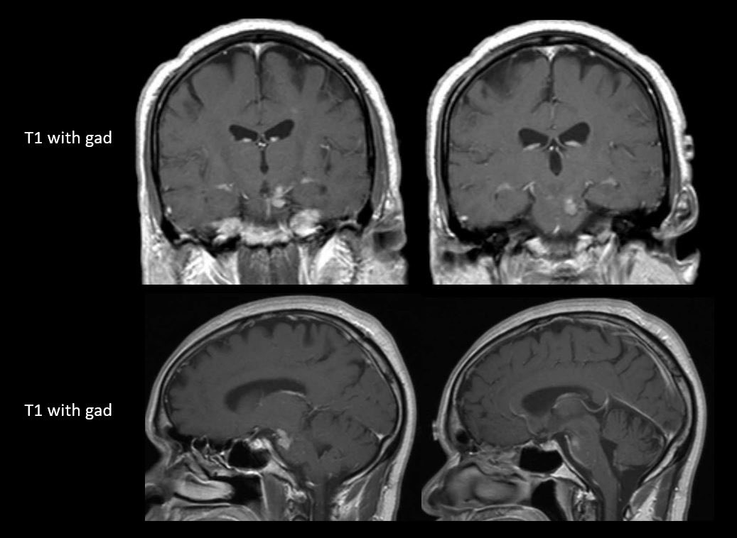 Jacques Morcos MD FRCS FAANS tweet media