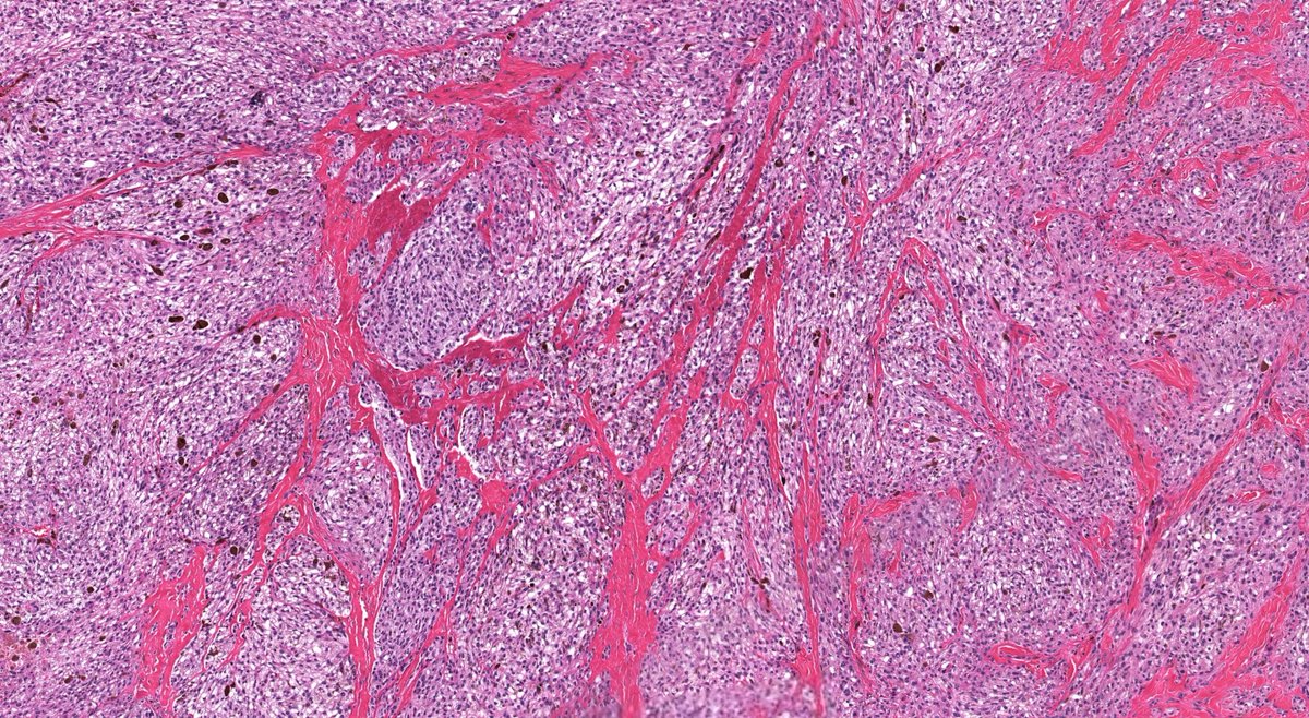 JMGardnerMD's tweet photo. 25 yo. Skin nodule on trunk. WSI digital slide &amp; immunostains: https://t.co/H94hHjM673. Your diagnosis? What's in differential dx &amp; how can you solve it? Answer: https://t.co/Nis5uFVK7H. #pathology #pathologists #pathTwitter #dermpath #dermatology #dermtwitter #BSTpath https://t.co/BkiyPWbXSA