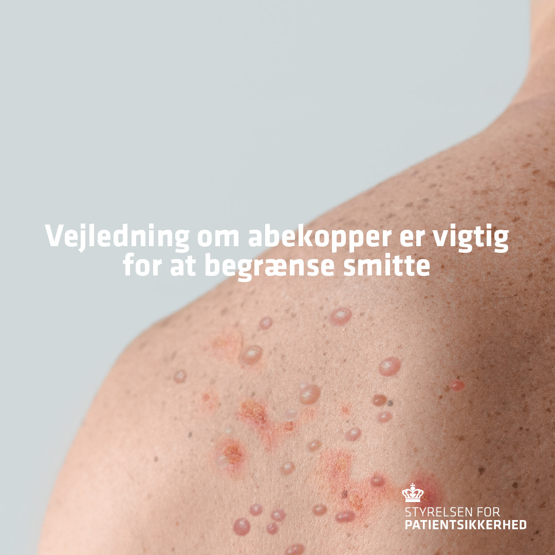 Styrelsen for Patientsikkerhed (@stps_dk) on Twitter photo Vejledning om #abekopper er vigtig for at begrænse smitteudbrud. Vores sundhedsberedskab hjælper derfor i øjeblikket smittede og deres nære kontakter med bl.a. isolations- og hygiejnespørgsmål. Retningslinjerne fra <a href="/SSTSundhed/">Sundhedsstyrelsen</a> kan læses her sst.dk/da/Viden/Smits… Vejledning om #abekopper er vigtig for at begrænse smitteudbrud. Vores sundhedsberedskab hjælper derfor i øjeblikket smittede og deres nære kontakter med bl.a. isolations- og hygiejnespørgsmål. Retningslinjerne fra <a href="/SSTSundhed/">Sundhedsstyrelsen</a> kan læses her sst.dk/da/Viden/Smits…