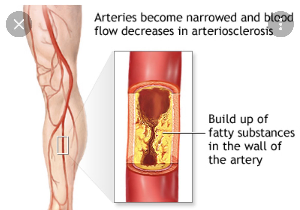 Тромбоз артерия и вена. Облитерирующий атеросклероз сосудов конечностей. Облитерирующий тромбофлебит. Атеросклероз сосудов нижних конечностей. Атеросклеротические бляшки в сосудах ног.