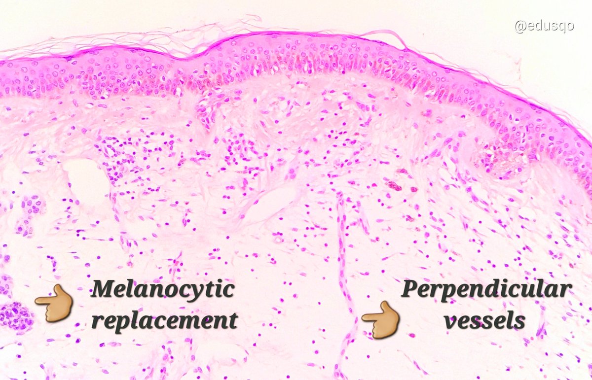 edusqo's tweet photo. Regression in melanocytic lesions:▫️Replacement of tumor cells by fibrous stroma.
▫️Chronic inflammation.
▫️Melanophages.
▫️Vascular proliferation (perpendicularly).
I found a great paper in @ActasDS by @CarlosMonteag20 and colleagues (PMID 28224168).
#DermPath #Dysplastic #Nevus https://t.co/FP45fXFuhV