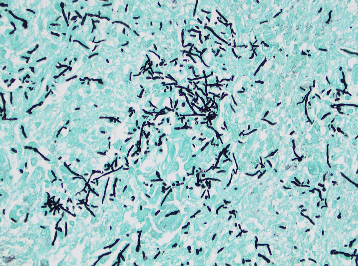 Cerebral phaeohyphomycosis: brain infection by darkly pigmented dematiaceous fungi. Notice melanin pigment in the fungal walls. Rare, often fatal, and occurrence is unrelated to immune status. #neuropath #pathology #purplepath 🧠 🔬