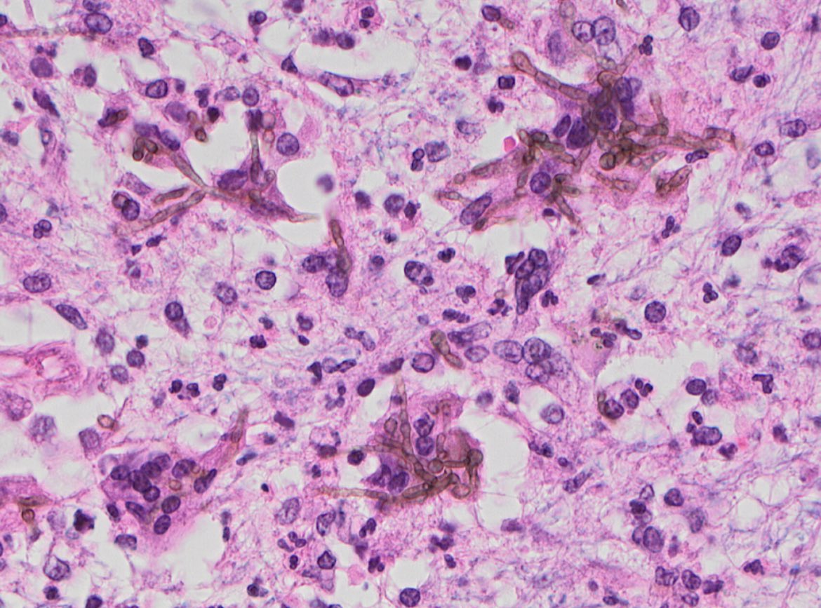 JaredAhrendsen's tweet photo. Cerebral phaeohyphomycosis: brain infection by darkly pigmented dematiaceous fungi. Notice melanin pigment in the fungal walls. Rare, often fatal, and occurrence is unrelated to immune status. #neuropath #pathology #purplepath 🧠 🔬 https://t.co/QUklsmj8gy