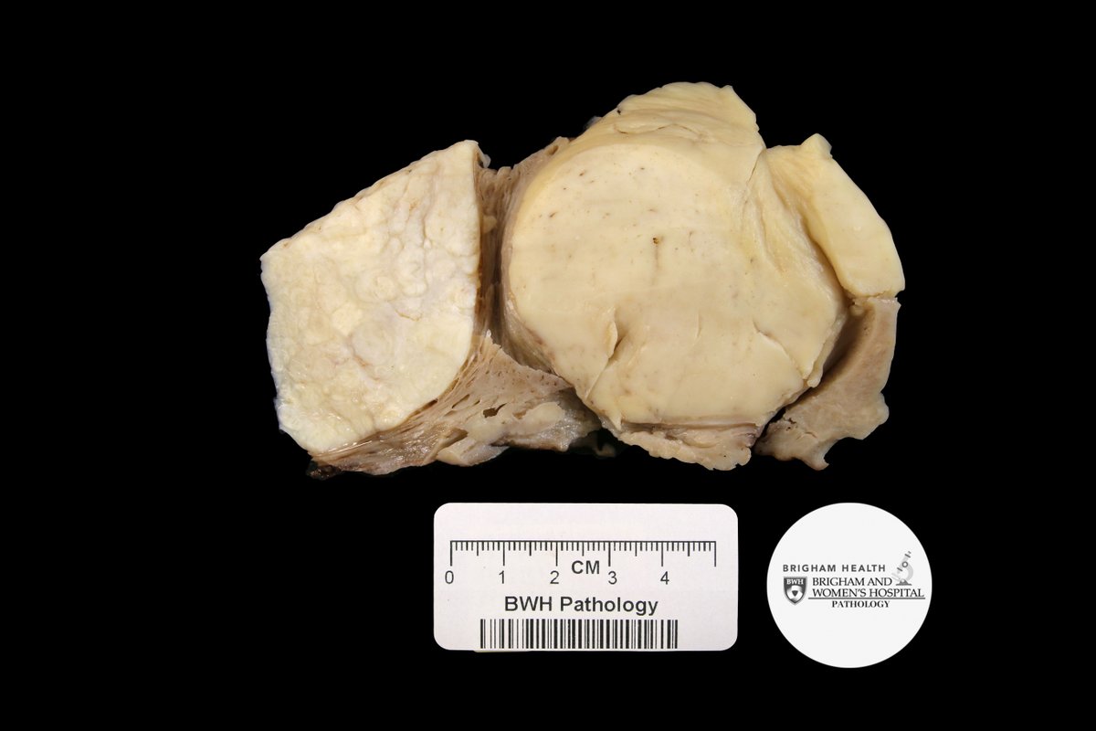 Hello and welcome to the Gross Case of the Week! This case displays very rare uterine mass. Can you name the lesion seen here? #GrossCOTW #PathAssist #BWHGynPathSummer 1/5