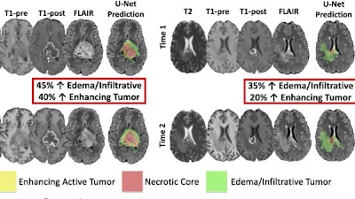 @UCSFimaging team trained 3D U-Net for longitudinal assessment of posttreatment diffuse glioma MRIs doi.org/10.1148/ryai.2… @RadRudie @DrDreMDPhD @NeuroDx #glioma #NeuroRad #MachineLearning