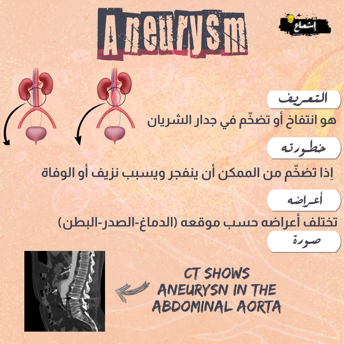 MedProjection's tweet image. وش يعني Aneurysm 🤔